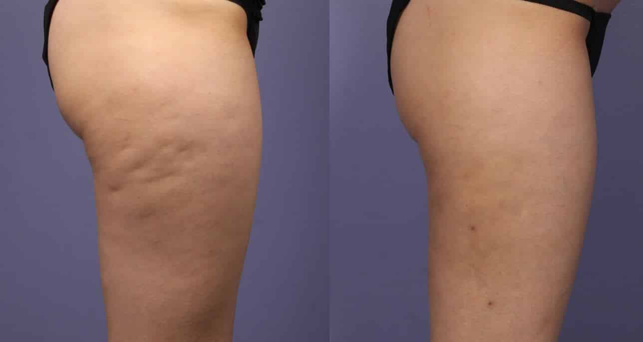 Come eliminare la cellulite: attività fisica e consigli alimentari